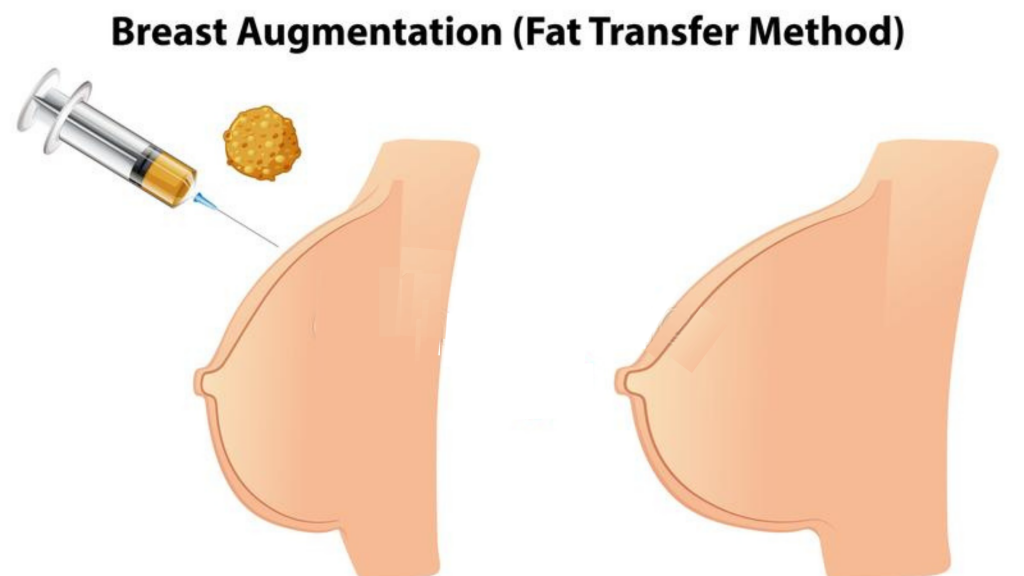 Fat Transfer