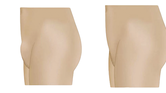 LIFTING PUBIc 1