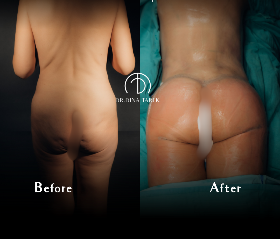 BBL, total body lift