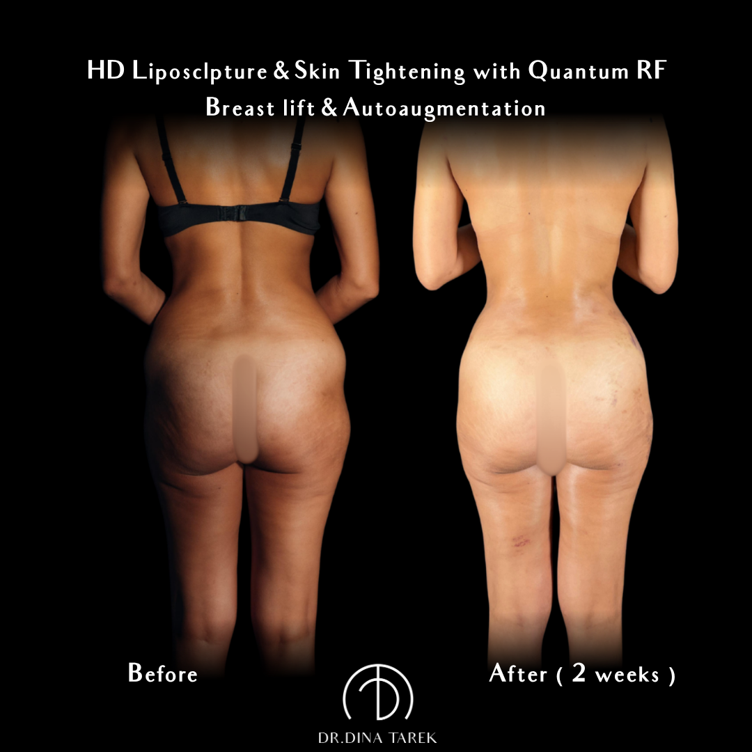 HD lipo, BBL
