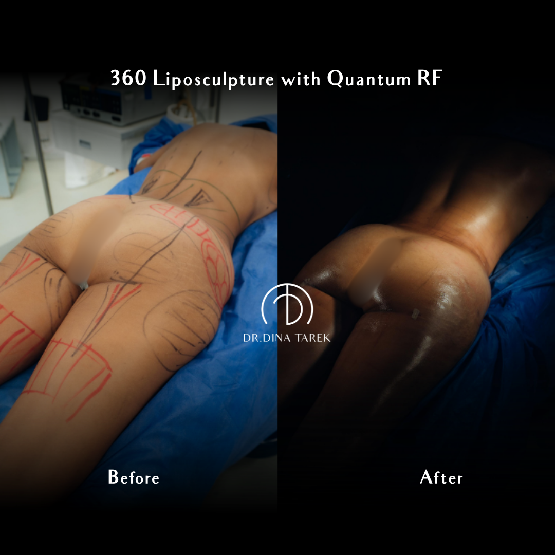 HD lipo, and quantum RF