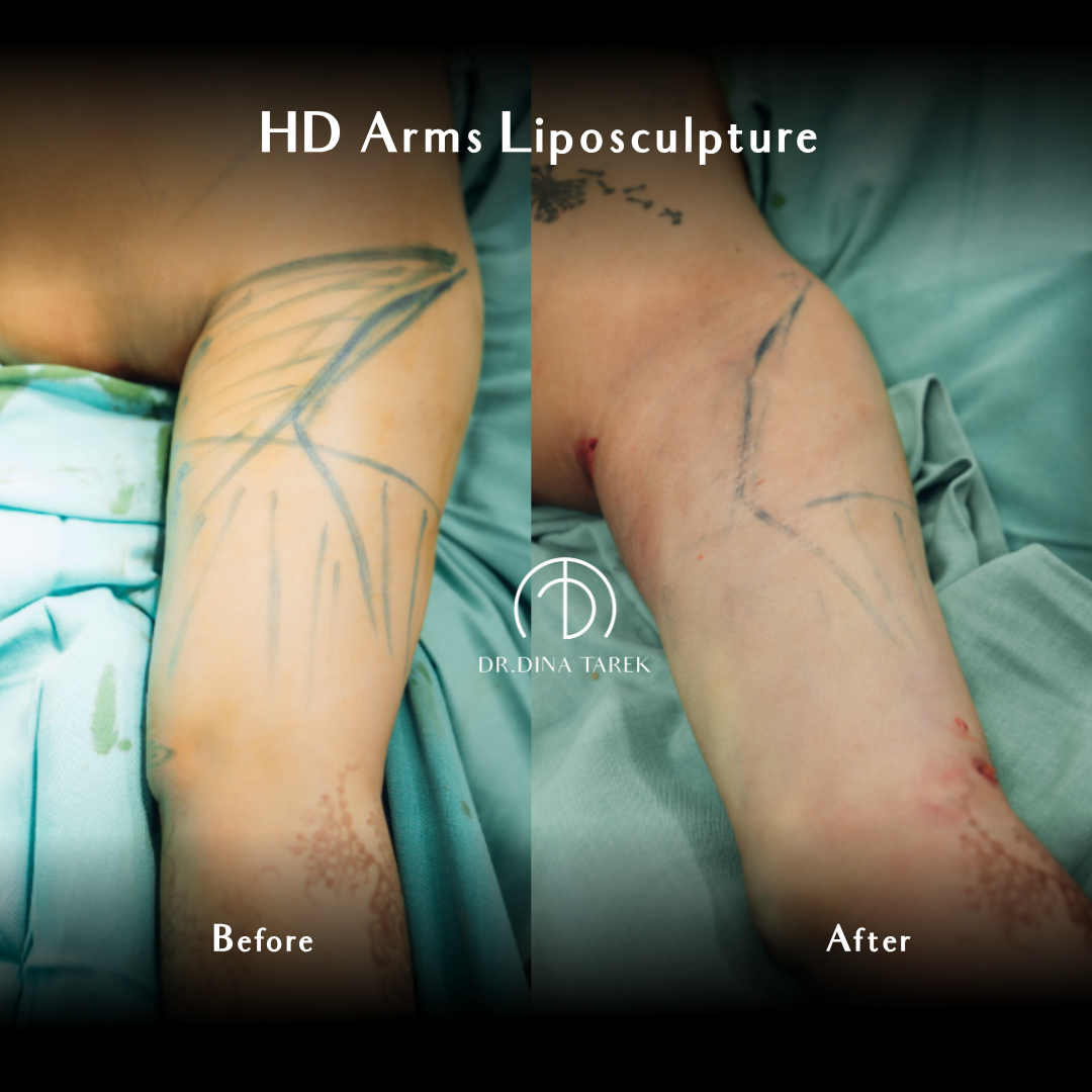 HD lipo arms 1