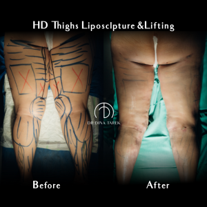 HD lipo thighs2 1