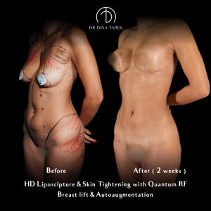 Hd lipo breast lift and mom makeover