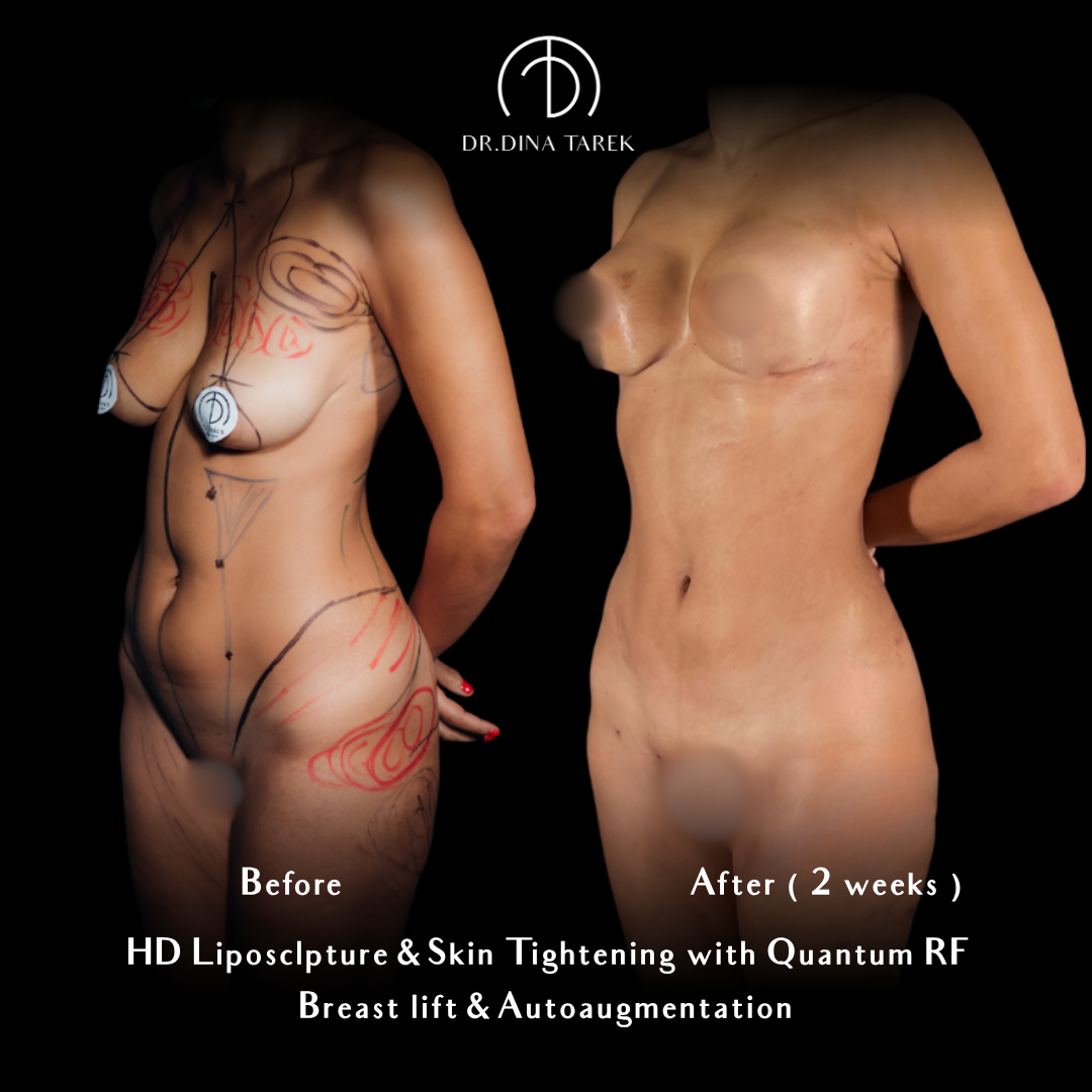Hd lipo, breast lift and mom makeover