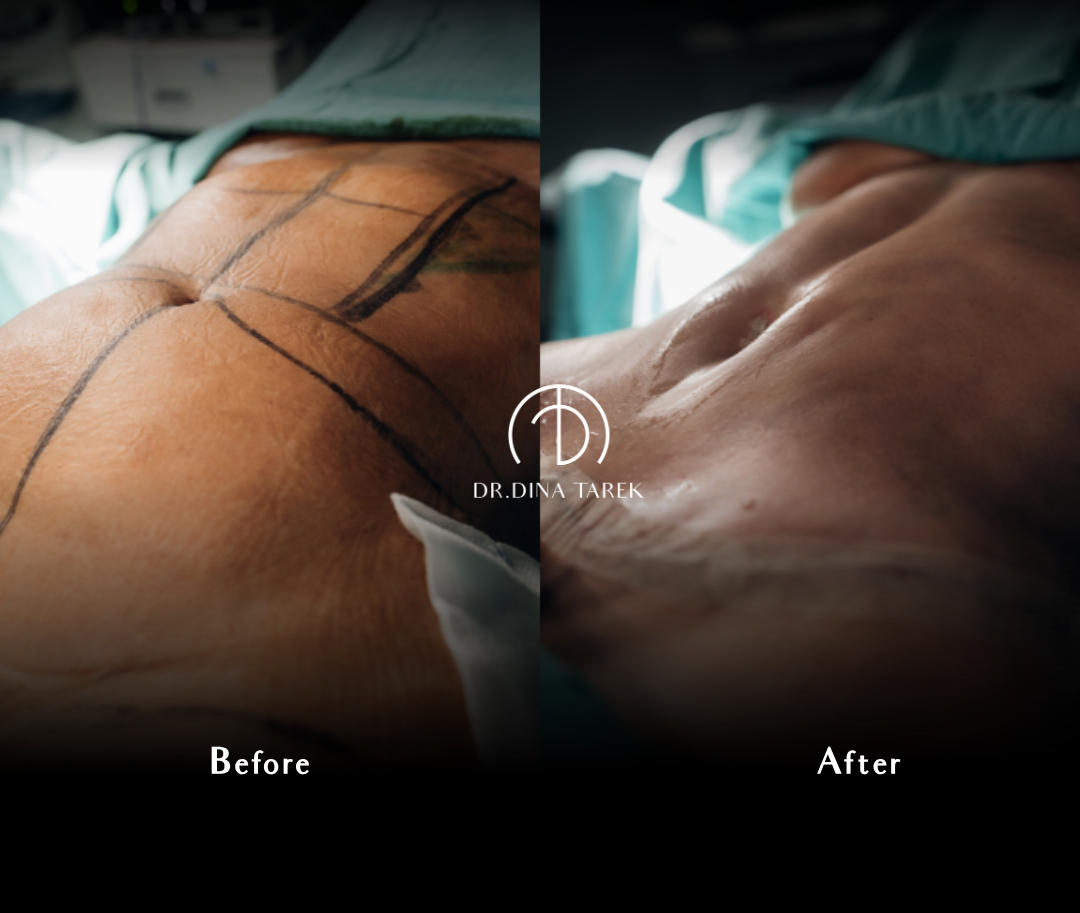Tummy tuck , mommy makeover, total body lift