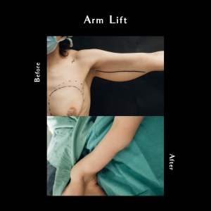 arm lift