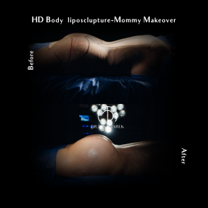 bbl HD lipo Mommy makeover