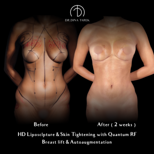 breast lift