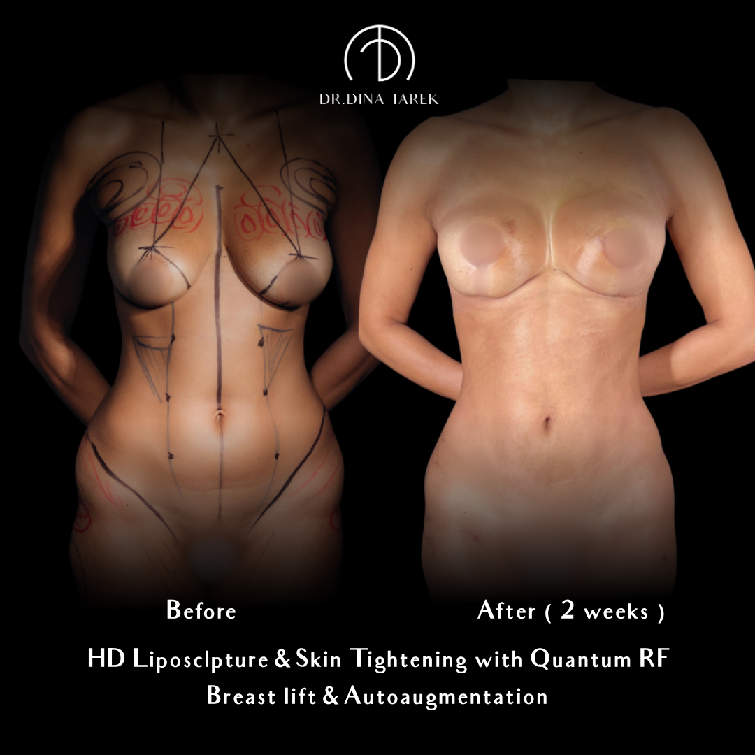 breast lift