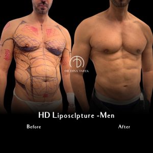 gynecomastia 3