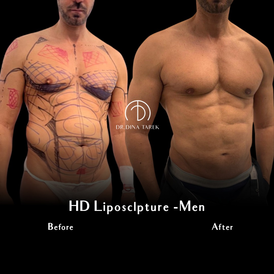 gynecomastia