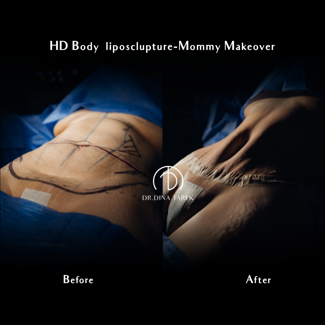 moomy makeover , Tummy tuck