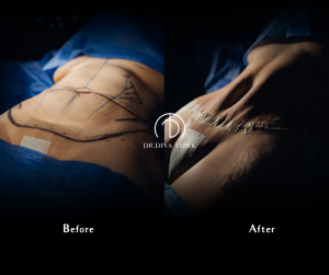 moomy makeover Tummy tuck 1 3